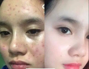 Read more about the article Gia công serum mụn thảo mộc – Gia công mỹ phẩm trọn gói tại TPHCM